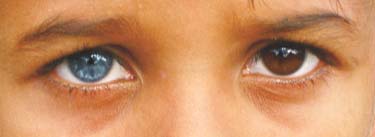 гетерохромия, разные глаза, цвет глаз детей