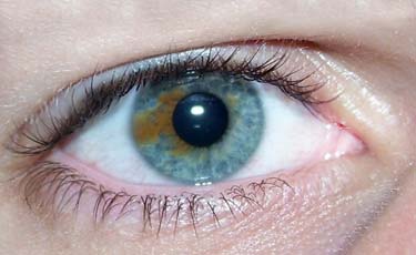 гетерохромия, частичная гетерохромия, разные глаза 